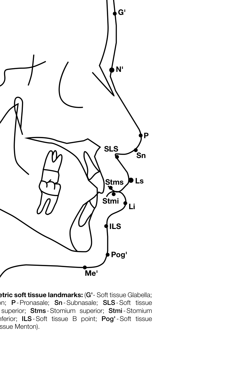 Figure 2. Cephalometric soft tissue landmarks: (G'- Soft tissue Glabella; N'-Soft tissue Nasion; P-Pronasale; Sn-Subnasale; SLS-Soft tissue A point; Ls-Labialis superior; Stms-Stomium superior; Stmi-Stomium inferior; Li-Labialis inferior; ILS-Soft tissue B point; Pog'-Soft tissue Pogonion; Me'-Soft tissue Menton).