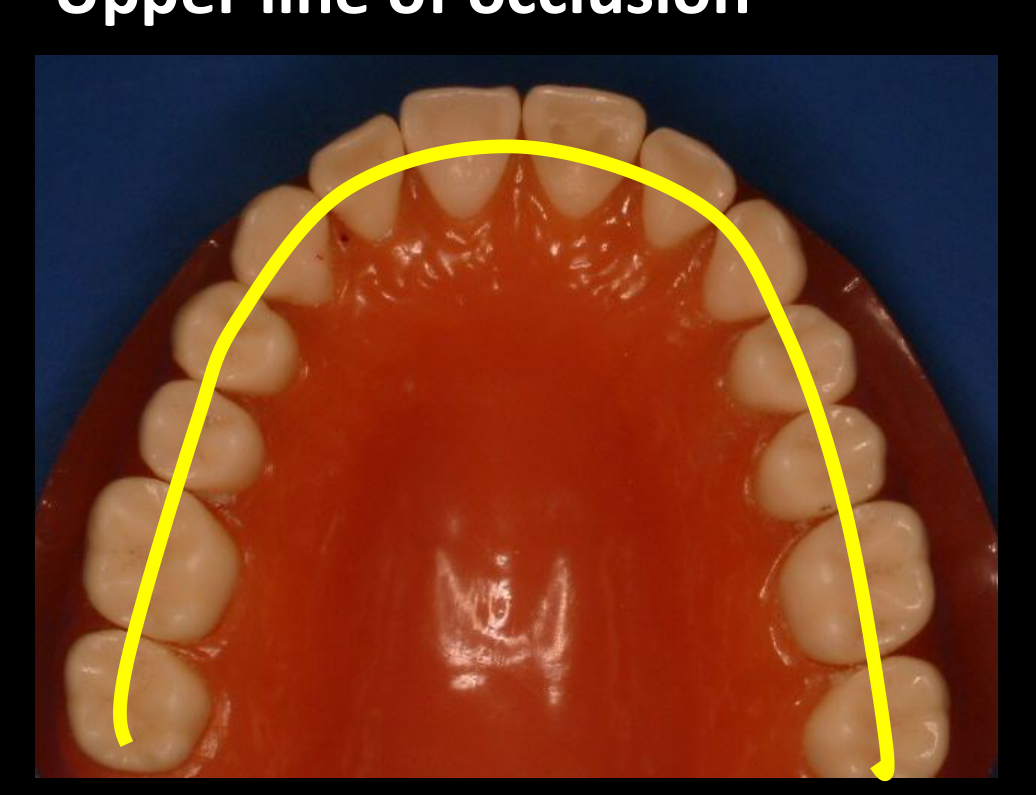 Upper line of occlusion
