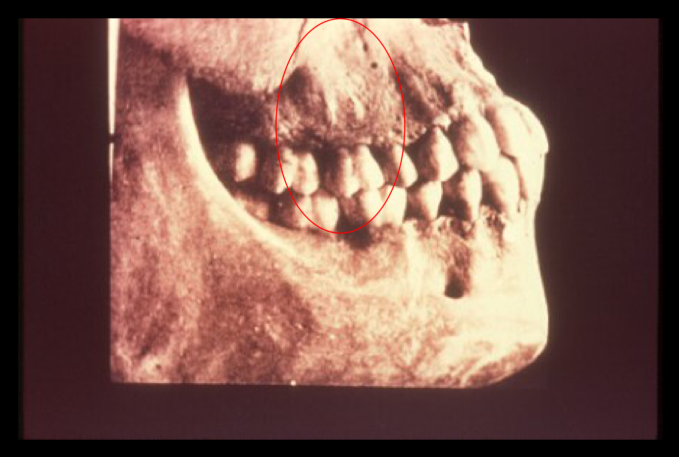 Zygomatic arch
