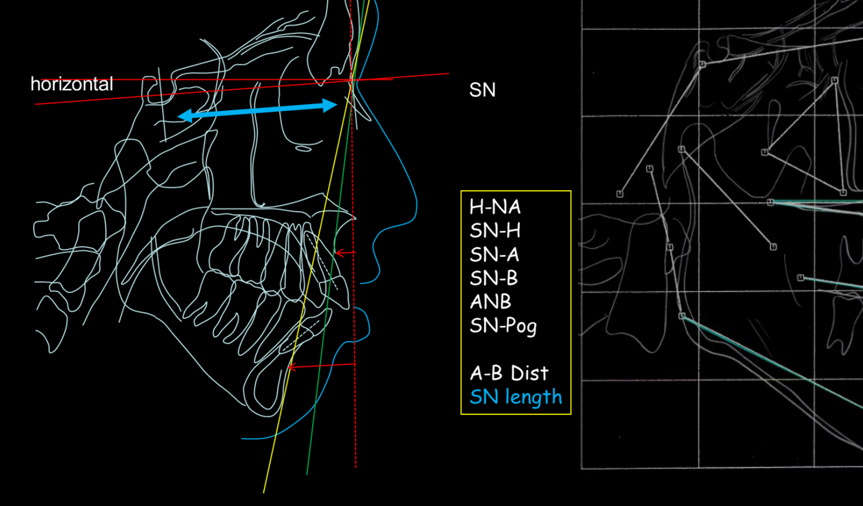 Cranial Base-maxilla-mandible