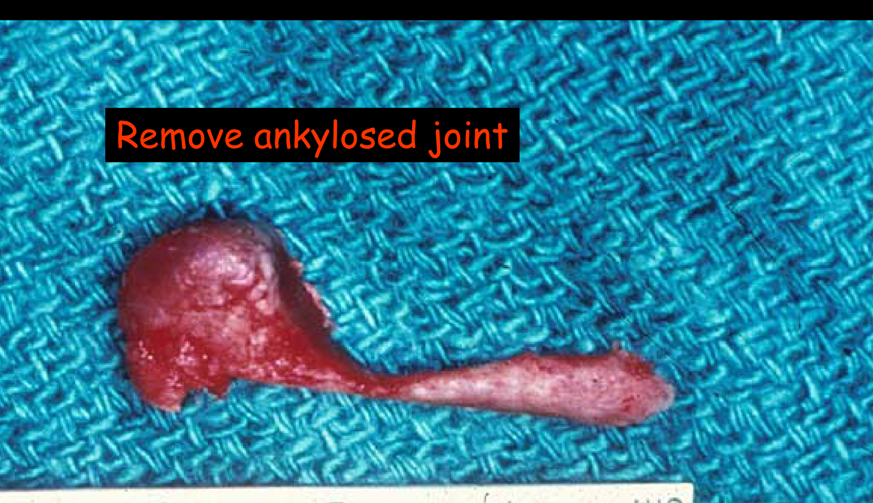 Remove ankylosed joint