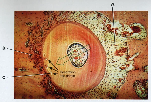 Coronal section, human premolar: This section from a human autopsy specimen shows how resorption of a tooth root can penetrate well into the dentin as a tooth is being moved—notice the craters in the root adjacent to the compressed side (B). (courtesy Dr. B. Melsen).