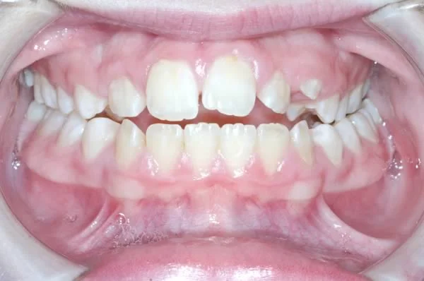 Class I malocclusion: This patient has a posterior crossbite and anterior open bite--neither of which you would know about if you were told that the diagnosis is Class I malocclusion.