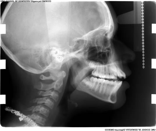 Ceph of patient seen on previous screen: This patient's anterior open bite has a skeletal component because the palatal plane, and to some extent the mandibular plane, are rotated in a way that increases anterior face height. So skeletal open bite is an appropriate description of one of her problems.