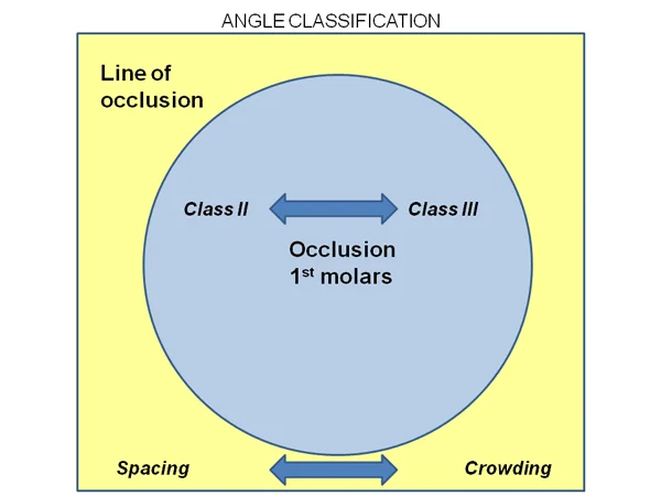Venn diagram, Angle classification: This diagram represents the Angle classification's two components and their relationship to each other symbolically, but really already goes beyond Angle's description. In this scheme, alignment information would be added to the Class II or Class III molar relationship, and Angle did not do that.