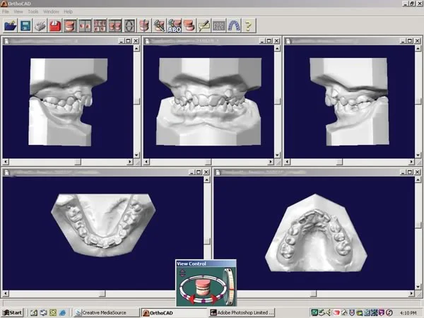 Virtual casts for evaluation of symmetry and crowding: Virtual casts on a computer screen are examined in the same way actual casts would be, evaluating symmetry within the arch and the amount of crowding or spacing.