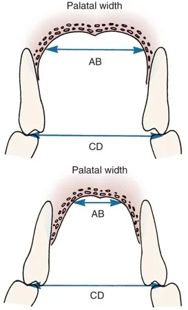 Dental vs. skeletal poserior crossbite: A dental posterior crossbite is characterized by normal width of the maxilla (seen in the upper image--note the width of the palatal vault), with the maxillary teeth leaning lingually. A crossbite of the same dimension can be produced by a narrow maxilla (revealed by a narrow palatal vault), with the teeth leaning facially in partial compensation (lower image).