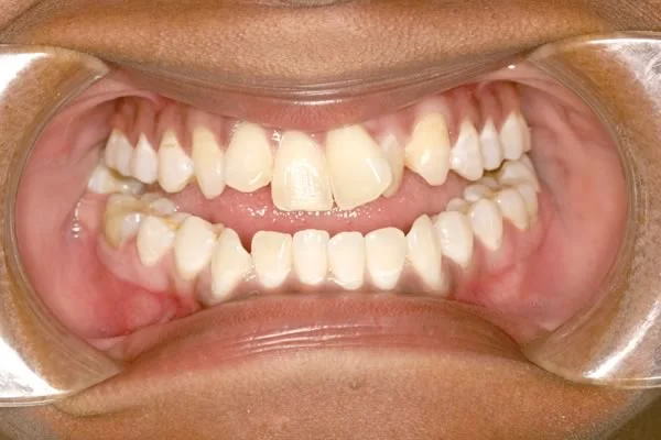 Posterior crossbite: wide mandibular arch?: This mandibular arch certainly looks quite wide, doesn't it? To confirm that this posterior crossbite is primarily due to an excessively wide mandibular arch, you could measure the width across the arches and compare this to normative data for arch width.