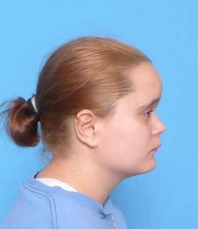 Skeletal or dental Class II?: From a careful analysis of the profile, you should be able to determine whether there is a skeletal component to the Class II malocclusion. Is the maxilla too far forward? Is the mandible too far back?