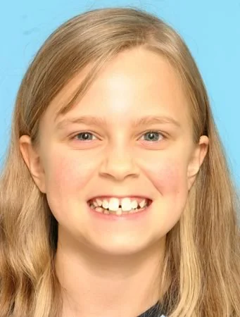 Class I crowding / protrusion: Malaligned and protruding teeth can create a significant psychosocial problem, to the point that this girl wants treatment to correct her teeth primarily because that will help her overcome a social acceptability problem.