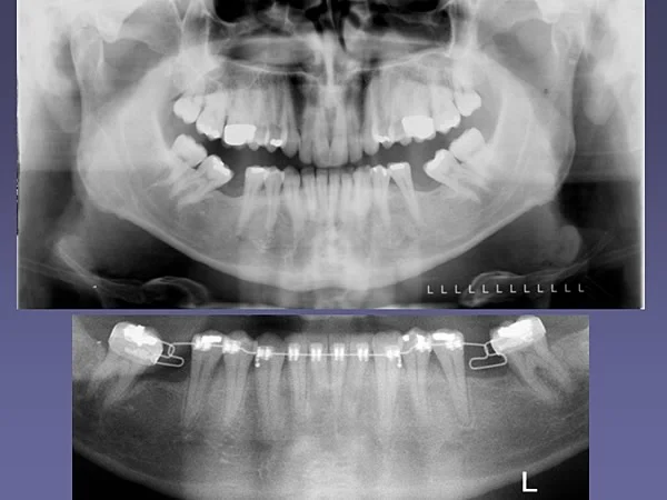 Molar uprighting to allow ideal restorations.