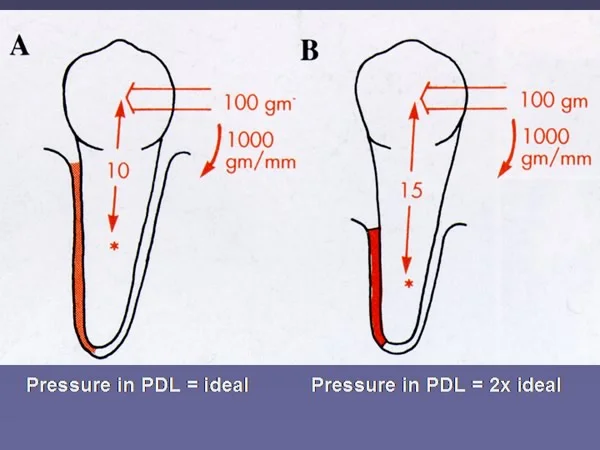 Bone loss means that orthodontic force must be reduced.