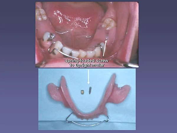 Removable appliance for repositioning of a molar.