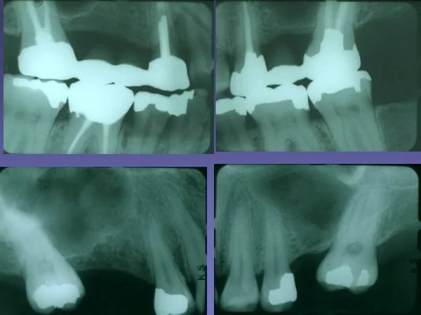 Before/after maxillary molar uprighting: for each side, pretreatment below, posttreatment above.