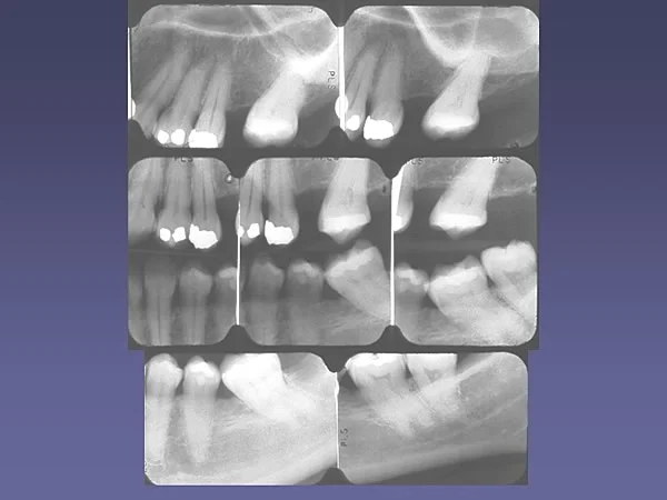 Closure of maxillary first molar extraction sites often is more feasible than closing mandibular extraction sites.