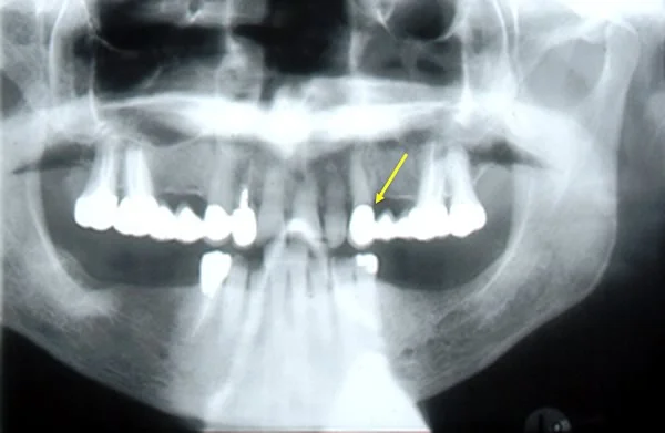 Panoramic radiograph, bridge failure, subgingival decay on maxillary left canine.