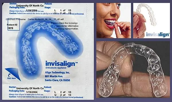 A series of aligners are worn sequentially full-time for 2 weeks or until the appliance is passive.