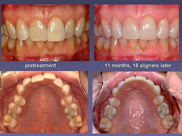 Before (left) and after 11 months of treatment with a series of aligners.