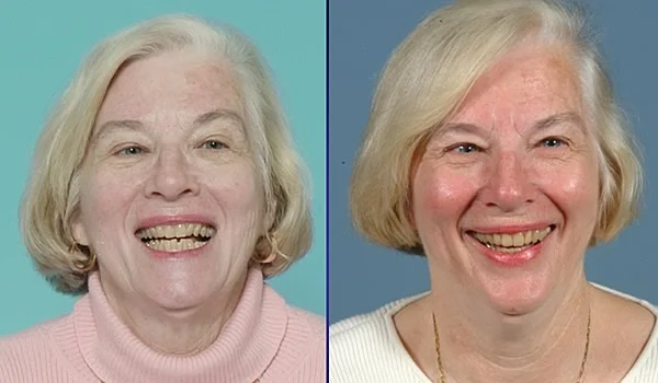 Smile before treatment and six months later.