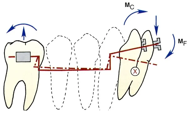 A two-couple system, created when an intrusion arch is tied into anterior brackets, is unpredictable because it's indeterminate.