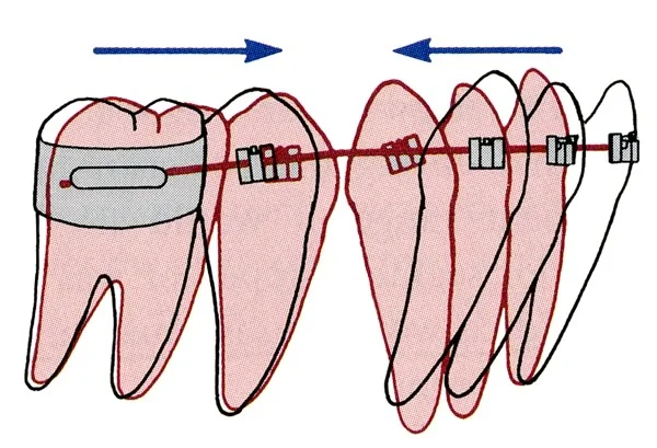 Stationary anchorage: the posterior anchor unit can only move bodily