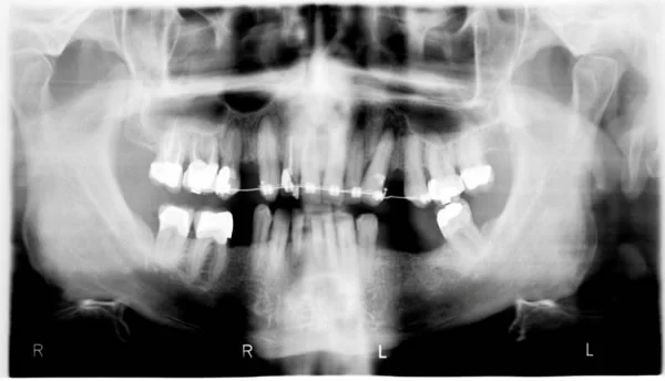 For this patient, the endo-treated maxillary lateral incisor will respond to orthodontic force like the other teeth.