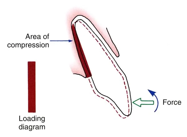 Bodily movement, created by the combination of a force (straight arrow) and a moment (curved arrow).