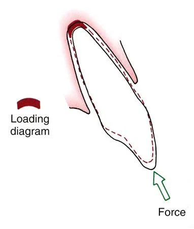 A force for intrusion creates pressure primarily in the small volume of the PDL at the apex of the root.