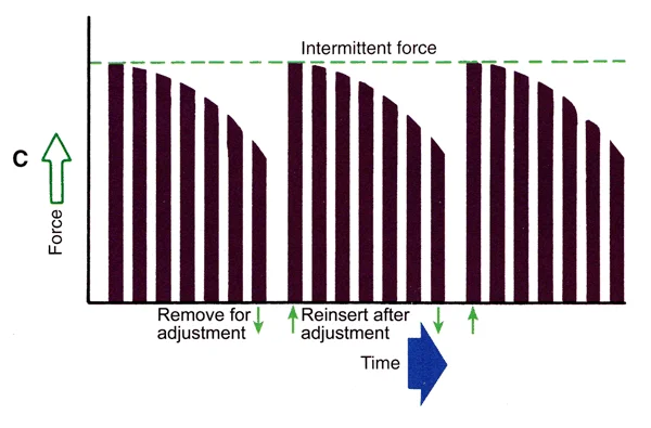 With a removable appliance, the force falls to zero when the appliance is removed, and is felt again when it is re-inserted. Such a force can be intermittently continuous if maintained until the next re-activation of the spring, or both intermittent and interrupted if the force falls to zero.