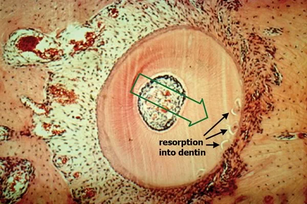 Resorption penetrating into the dentin (courtesy Dr. Birte Melsen).
