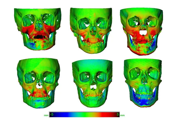3D superimposition, frontal view: The amount of change relative to the cranial base during treatment is shown in these color maps. Note the variation in response, from major advancement of the midface to little or no effect on the maxilla but restraint of mandibular growth.
