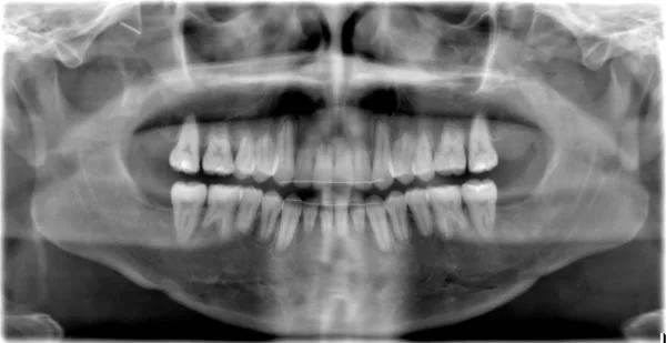 Severe generalized resorption--which fortunately is quite rare
