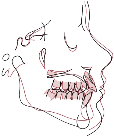 A patient's ceph tracing (black) superimposed (cranial base superimposition) on a Bolton template (red). The differences between the patient and the template then can simply be observed.