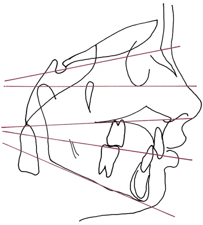 Completed tracing with horizontal reference lines added.