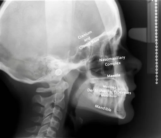 Cephalometric radiograph with the five components of the face labeled.
