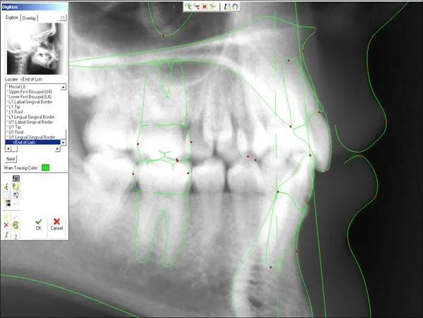 In tracing the lips and incisor teeth, it is important to get root inclination correct. Note the points for digitization of the incisors.
