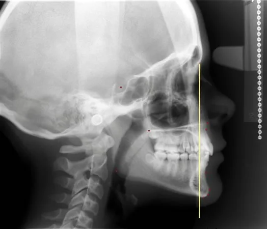 Note the relationship of both jaws to the N-perpendicular line. This is a quick way to confirm normal a-p relationships, as for this patient, or determine the underlying cause of a malocclusion.