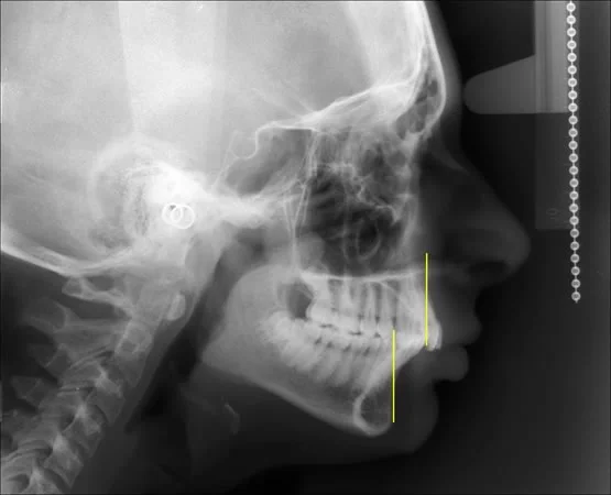 In this skeletal Class II patient, the relationship of the incisors to a vertical line through points A and B makes it obvious that the lower incisors are much more protrusive than the upper incisors.