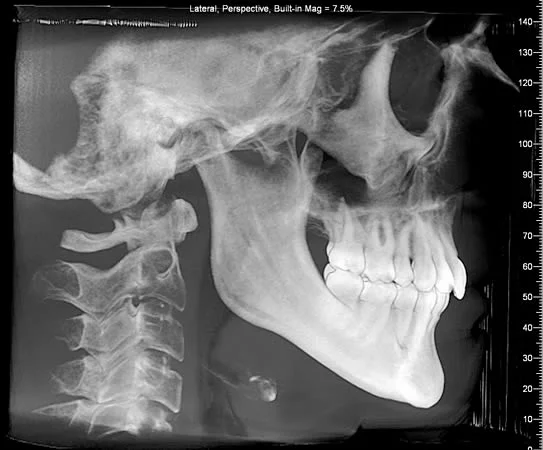 "Synthetic ceph" generated from CBCT images: Analysis of a synthetic ceph is similar to that of a 2-D digital ceph.
