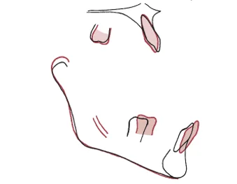 Changes in the maxillary and mandibular teeth relative to their supporting bone, during this individual's adolescent growth spurt.