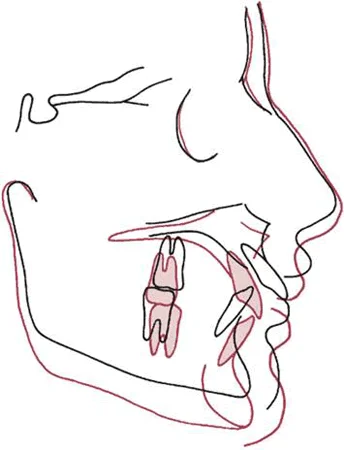 Cephalometric superimposition on the cranial base, showing downward and backward growth of the maxilla and downward growth of the mandible over a treatment period of a year.