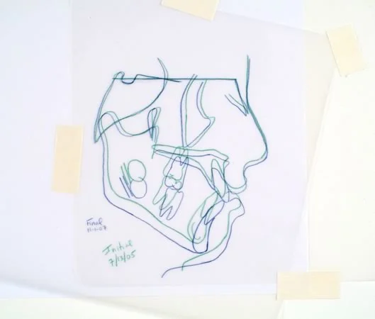 Superimposed tracings