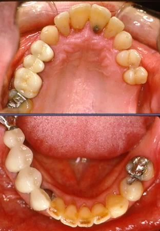 James, age 29, bridges serving also as permanent retainers.