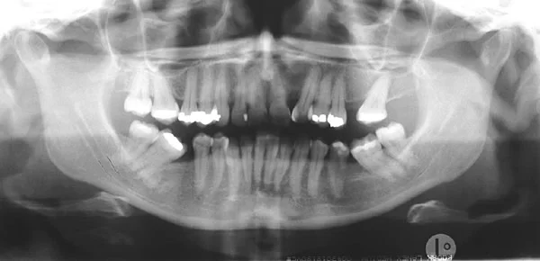 Pre-tx pan: June, age 45, prior to treatment.
