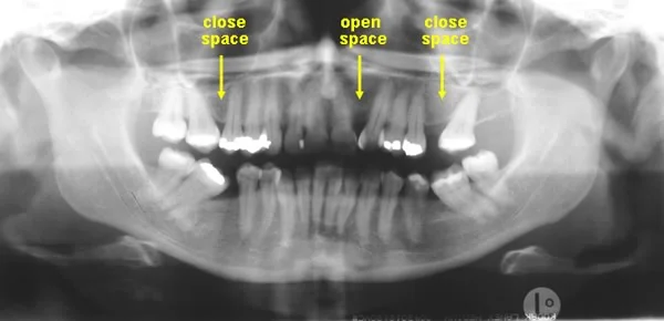 Maxillary arch, treatment plan.