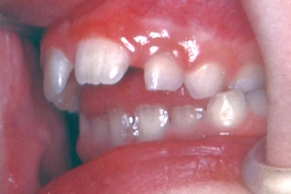 Tongue thrust?