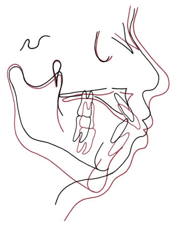 Cephalometric superimposition showing the effect of complete nasal blockage. Note the striking downward and backward mandibular growth (red shows the later time point).