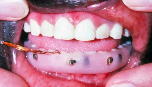 Pressure transducers to measure lip pressure (similar transducers behind the teeth are measuring tongue pressure).