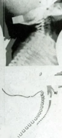 Infant airway radiographed at birth in the 1960's.