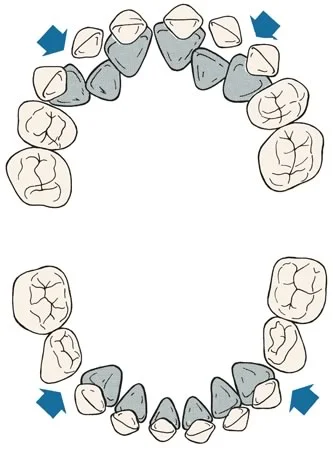 Primate spaces: The arrows indicate the location of the primate spaces in the maxillary and mandibular arches.
